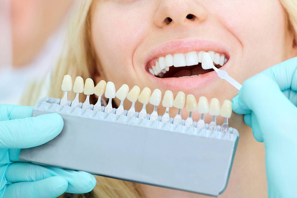 Blanqueamiento dental