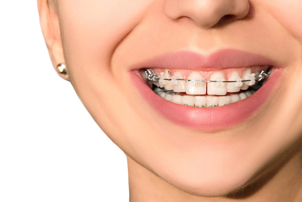 Ortodoncia brackets estéticos